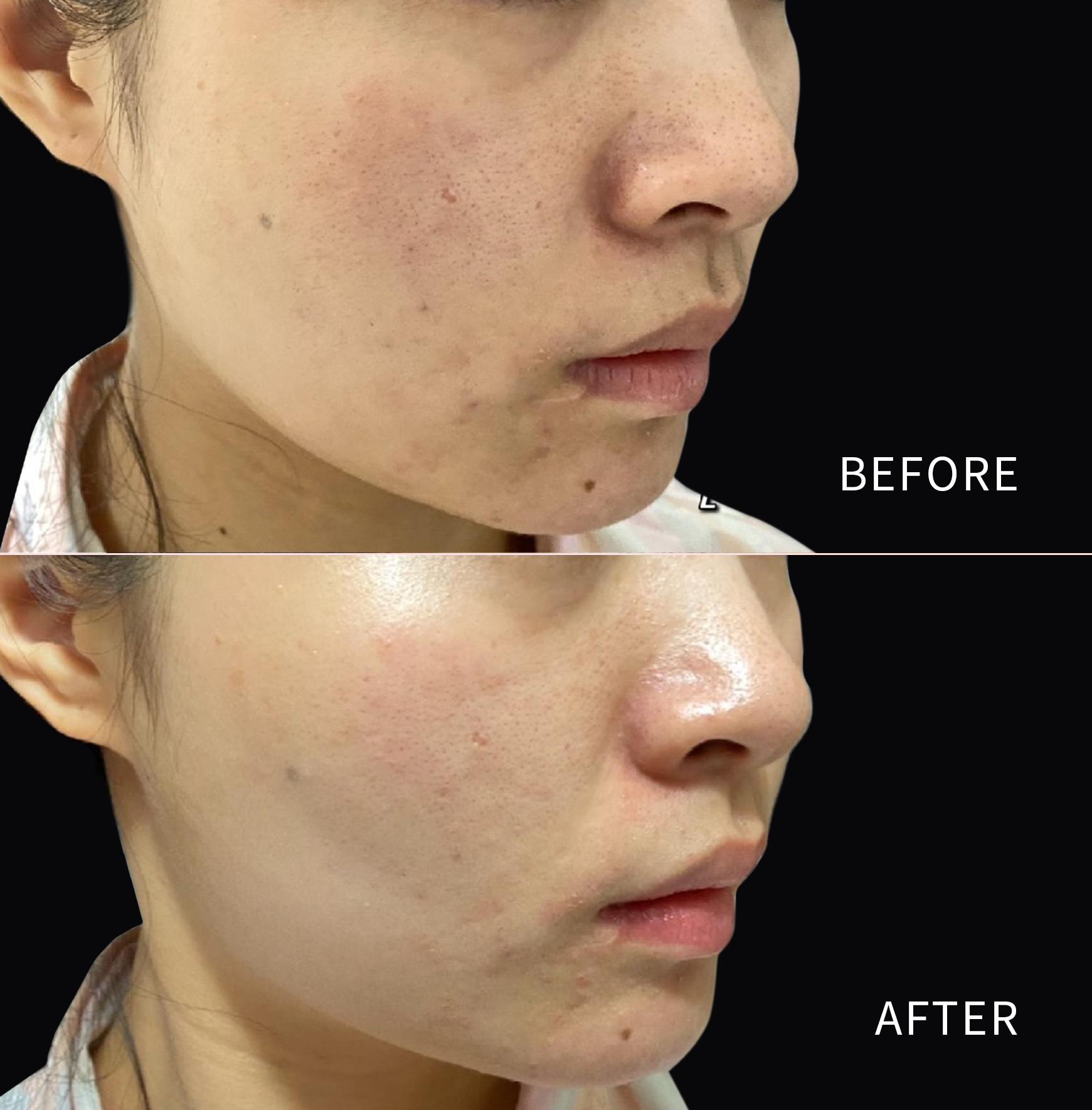 Lutronic® Infini™ RF Microneedling