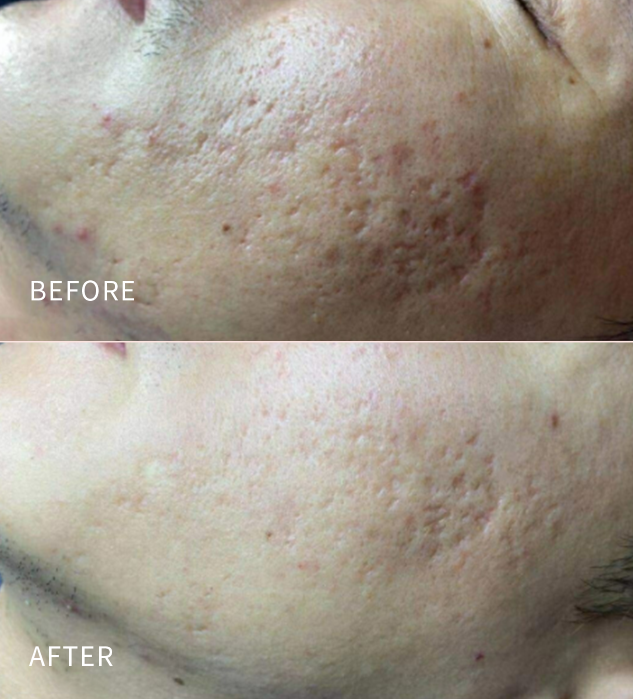 Lutronic® Infini™ RF Microneedling