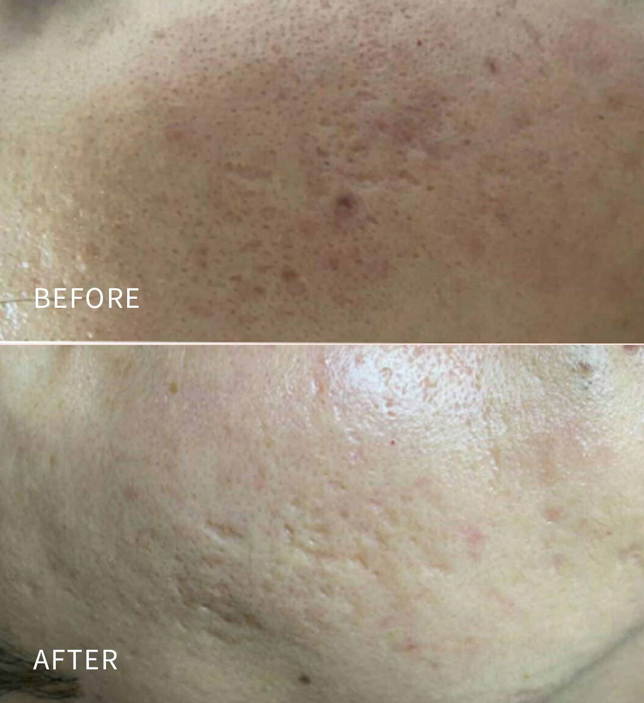 Lutronic® Infini™ RF Microneedling