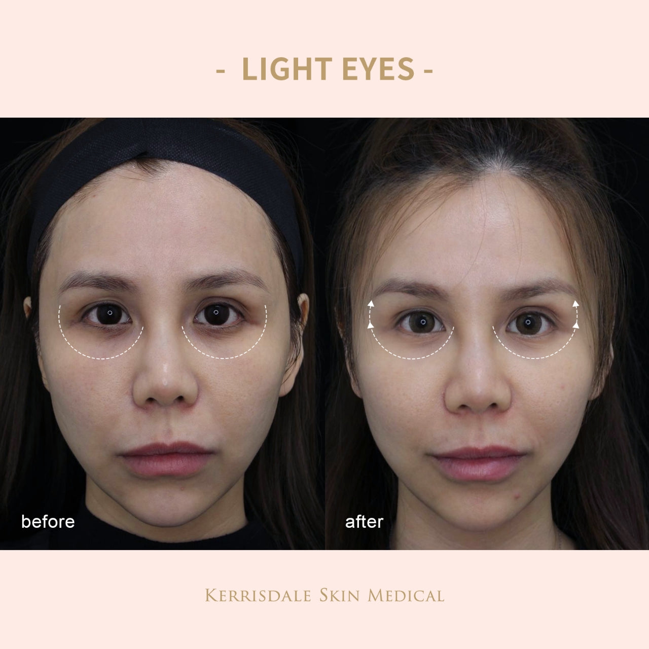 Light Eye Treatment +PDRN