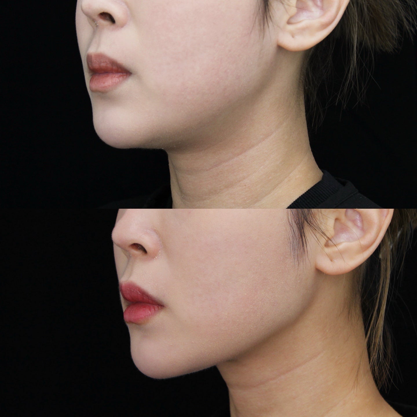 Ultherapy®